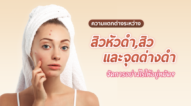 ความแตกต่างระหว่าง สิวหัวดำ สิว และ จุดด่างดำ จัดการอย่างไรให้อยู่หมัด