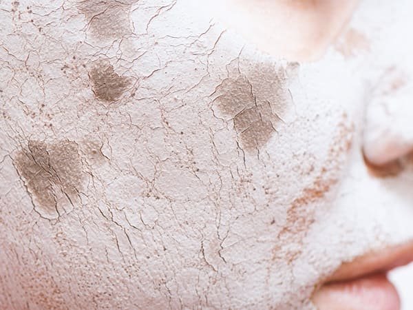 ผิวขาดน้ำ