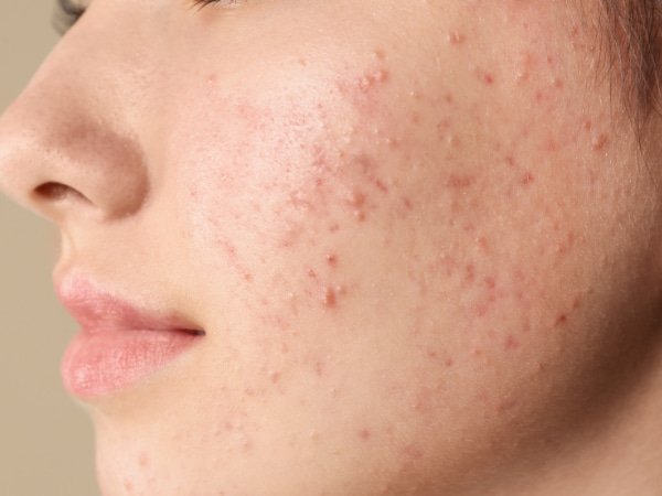 รอยสิว เกิดจากอะไร