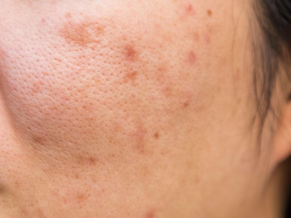 รอยดำ รอยแดงจากสิว