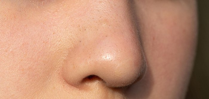 สิวอุดตันหัวเปิด หรือสิวหัวดำ