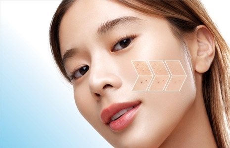 เป็นสิวอุดตันใช้อะไรดี