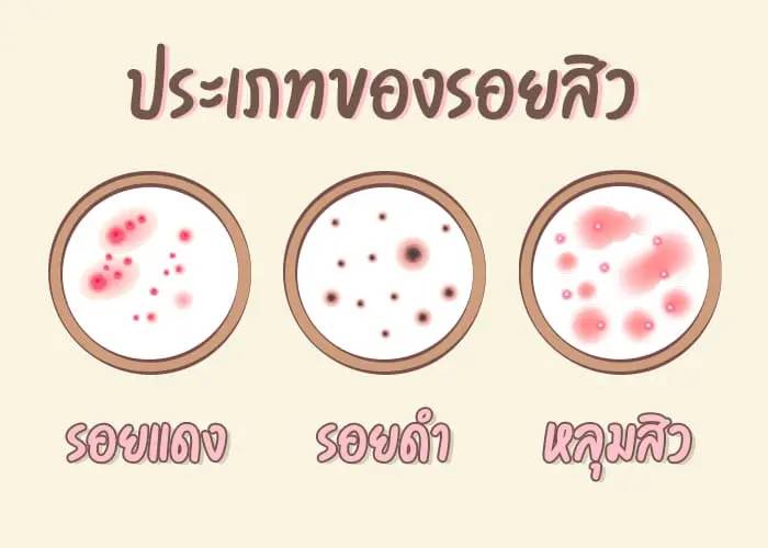 ประเภทของรอยสิว