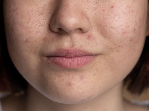 เลือกใช้ครีมกันแดดไม่อุดตันผิว