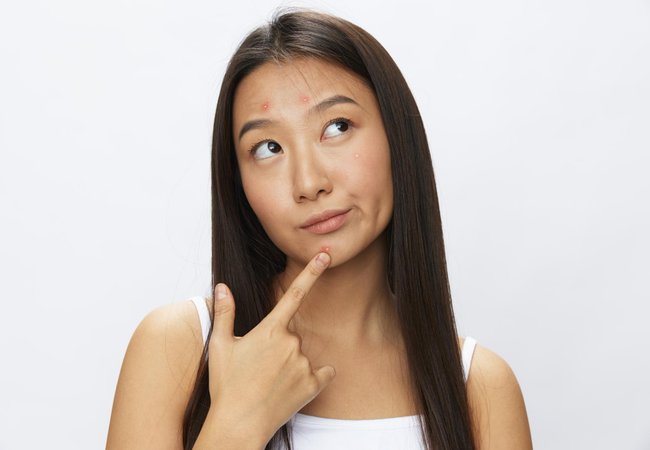 รอยสิว vs หลุมสิว