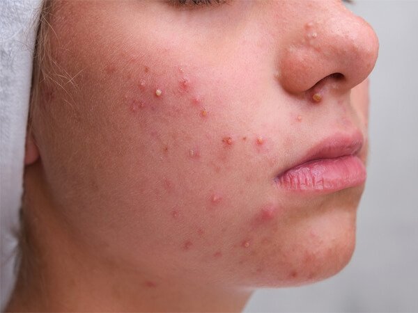 ปัจจัยที่ทำให้เกิดสิวอุดตัน