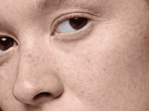 ฝ้า เกิดจาก