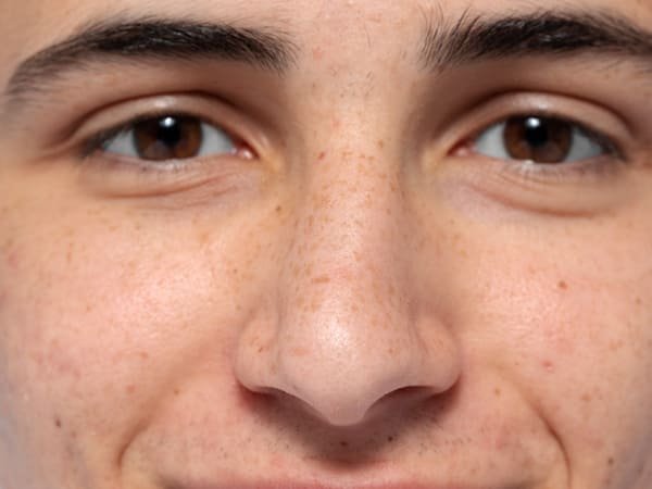 ฝ้า แดด' ลักษณะ