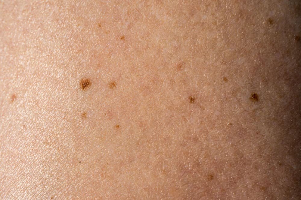 จุดเกิดฝ้า