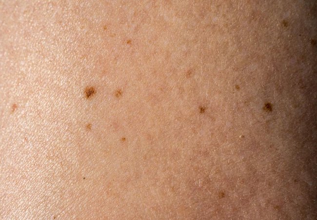 จุดเกิดฝ้า