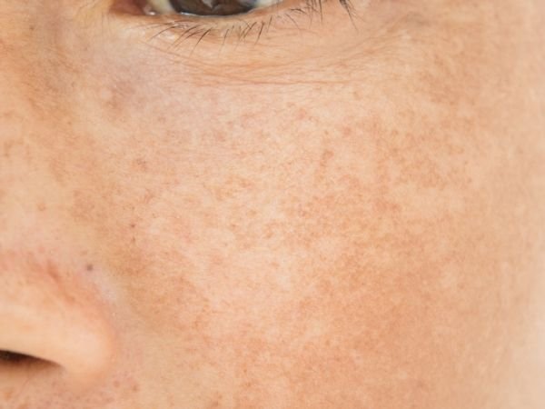 ปัญหาฝ้า