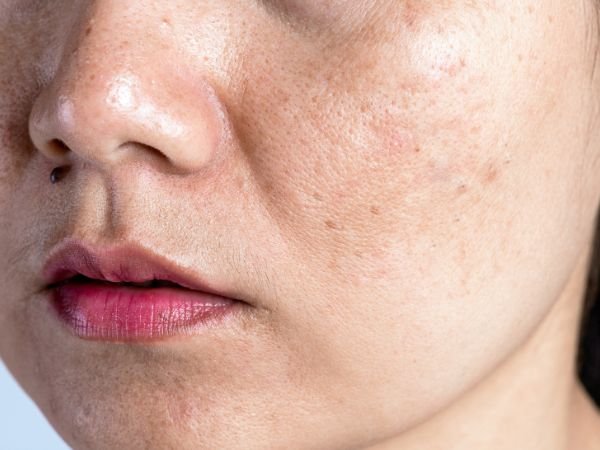 ปัญหารอยสิวและฝ้า